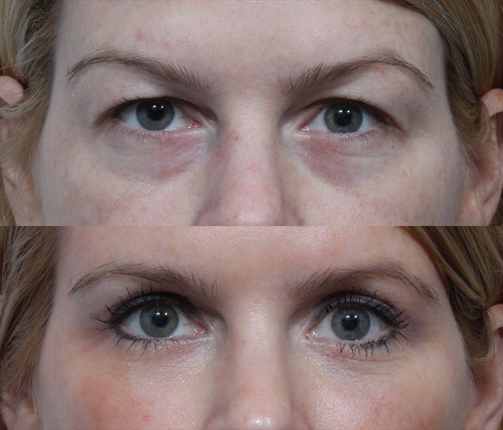 Pre and Publish Surgery Factors You Should Know Just Before An Eyelid Surgery Santa Barbara post thumbnail image